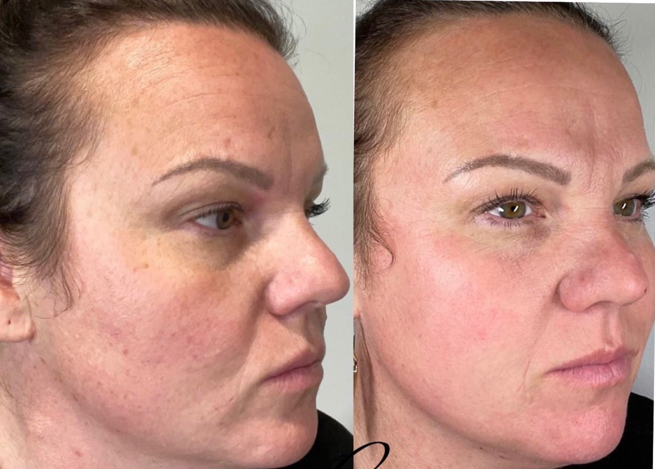 Erbium Laser Resurfacing  Blackledge Face Center Jackson MS